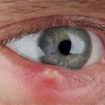 Pessoa com desconforto ocular causado por terçol durante período de clima seco
