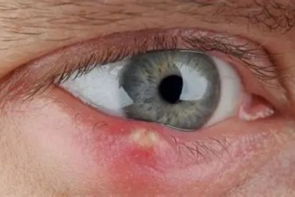 Pessoa com desconforto ocular causado por terçol durante período de clima seco