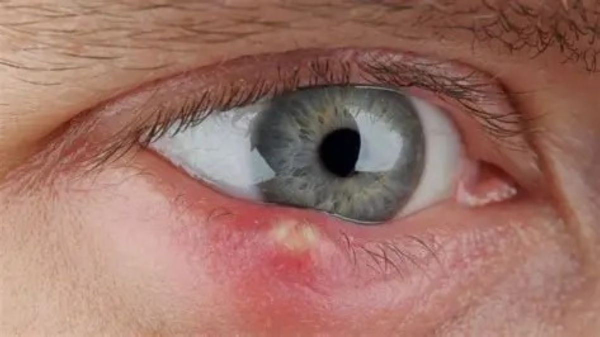 Pessoa com desconforto ocular causado por terçol durante período de clima seco